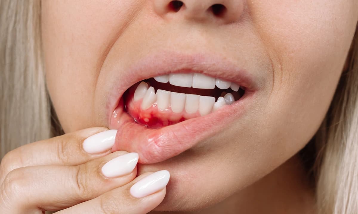 علاج التهاب اللثة