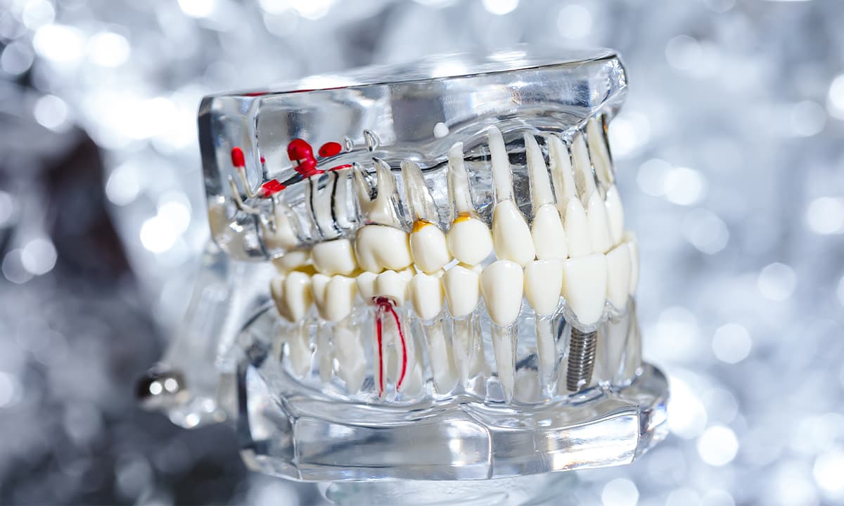 Kanal Tedavisi (Endodonti)