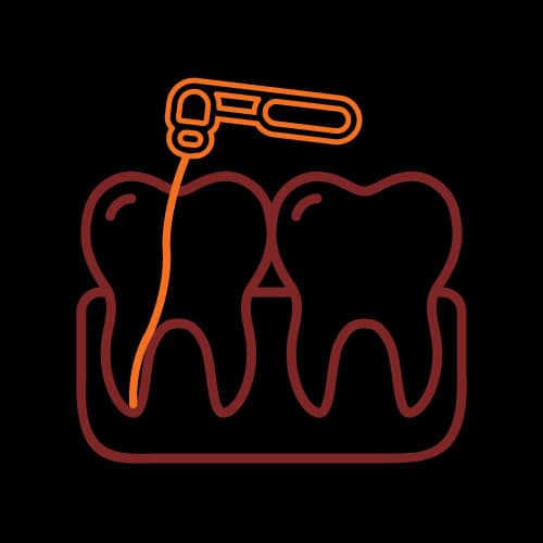 علاج الجذور (Endodontics)