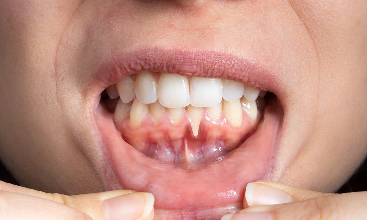 Diş Eti Hastalıkları (Periodontoloji)