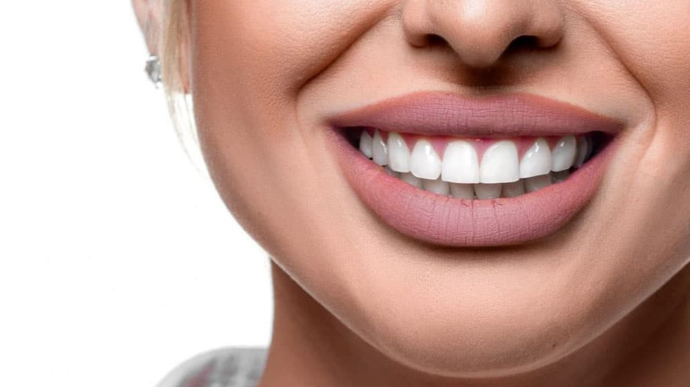 Hollywood Smile Nedir, Kimler Yaptırabilir?